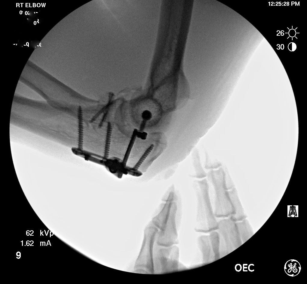X-ray of right elbow containing plates and screws